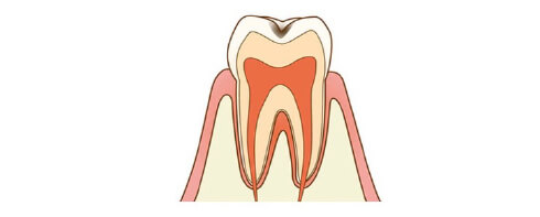 C1 Minor tooth decay