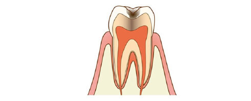 C2 Moderate tooth decay