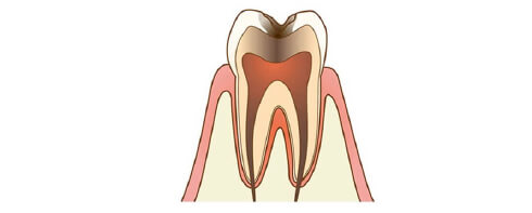 C3 Severe tooth decay