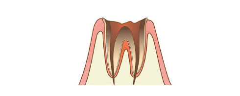 C4 Most Severe tooth decay